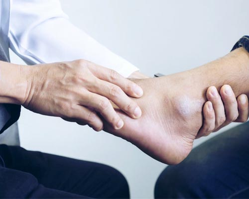 ankle sprain treatment